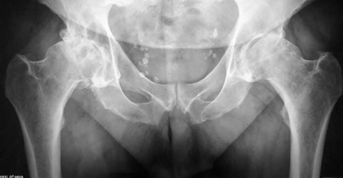Tratamiento de fracturas de cadera