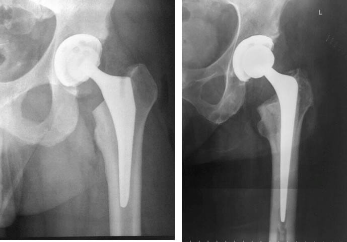 Cirugia artroscopica de cadera