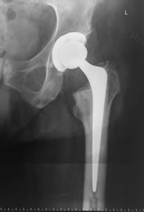Tratamiento de fracturas de cadera