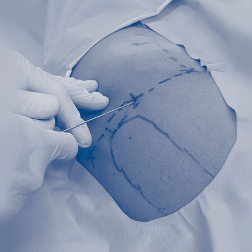 Tratamientos biologicos para cadera